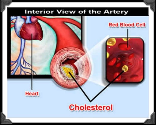Ilustrație: secțiune prin arteră cu depunere de colesterol